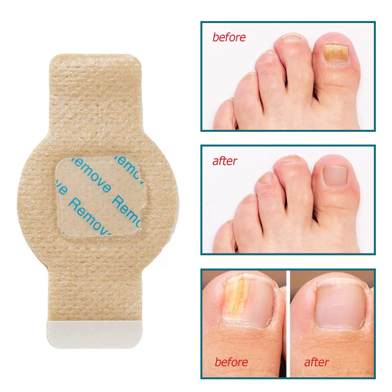 Hydrogel Nail Fungus Protection Patches