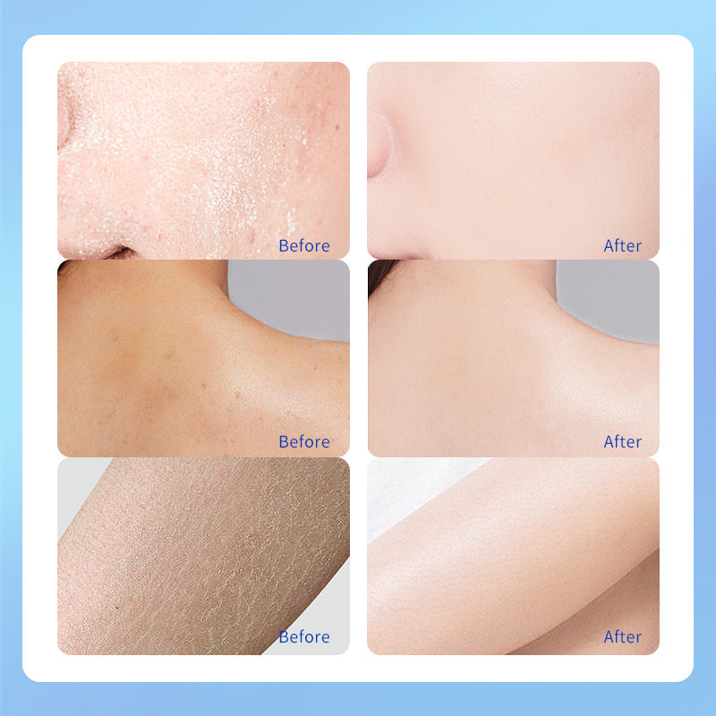 Urea Cream