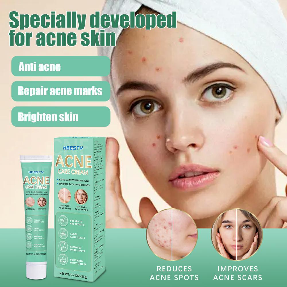 Herbal Acne Treatment Cream