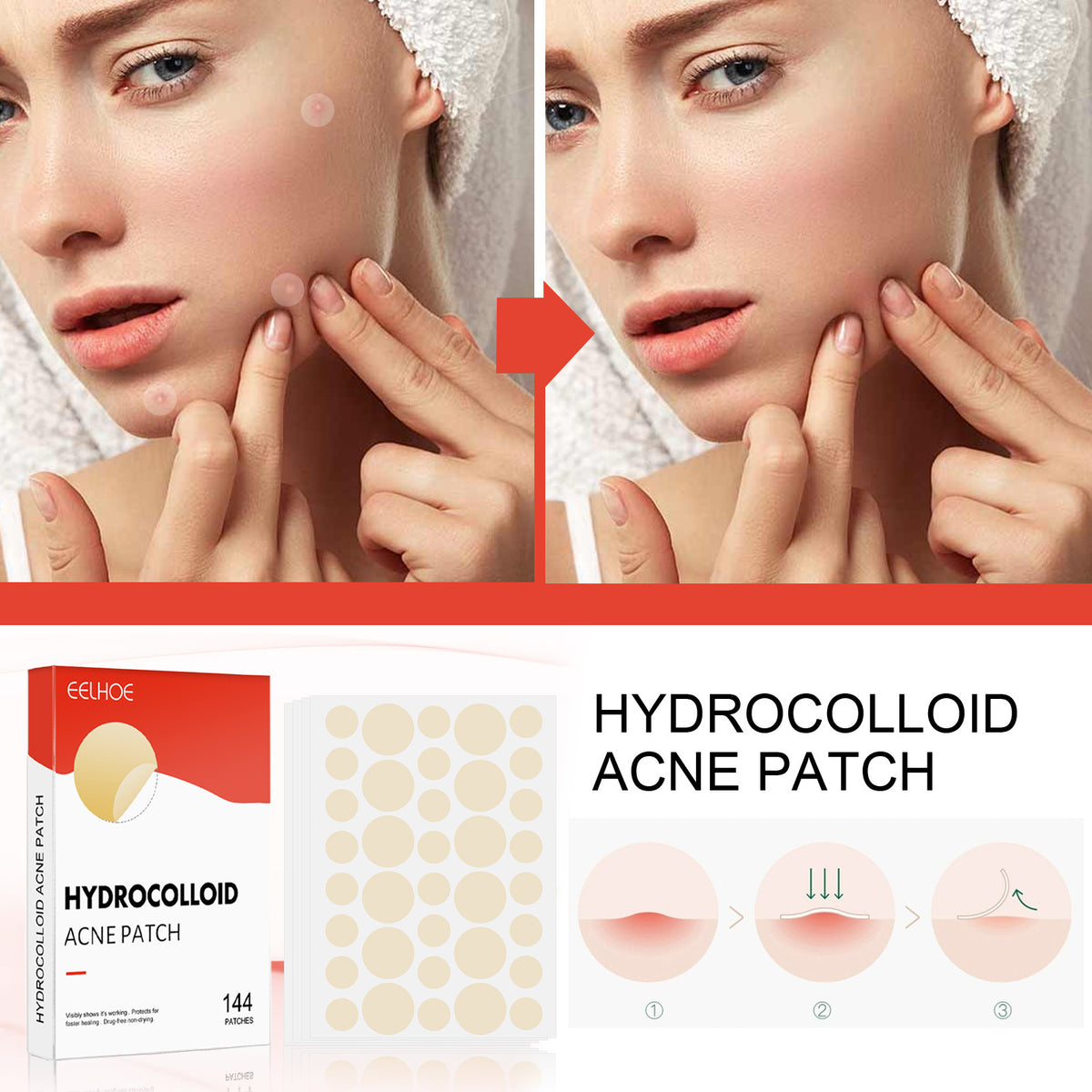 Hydrocolloid acne patch
