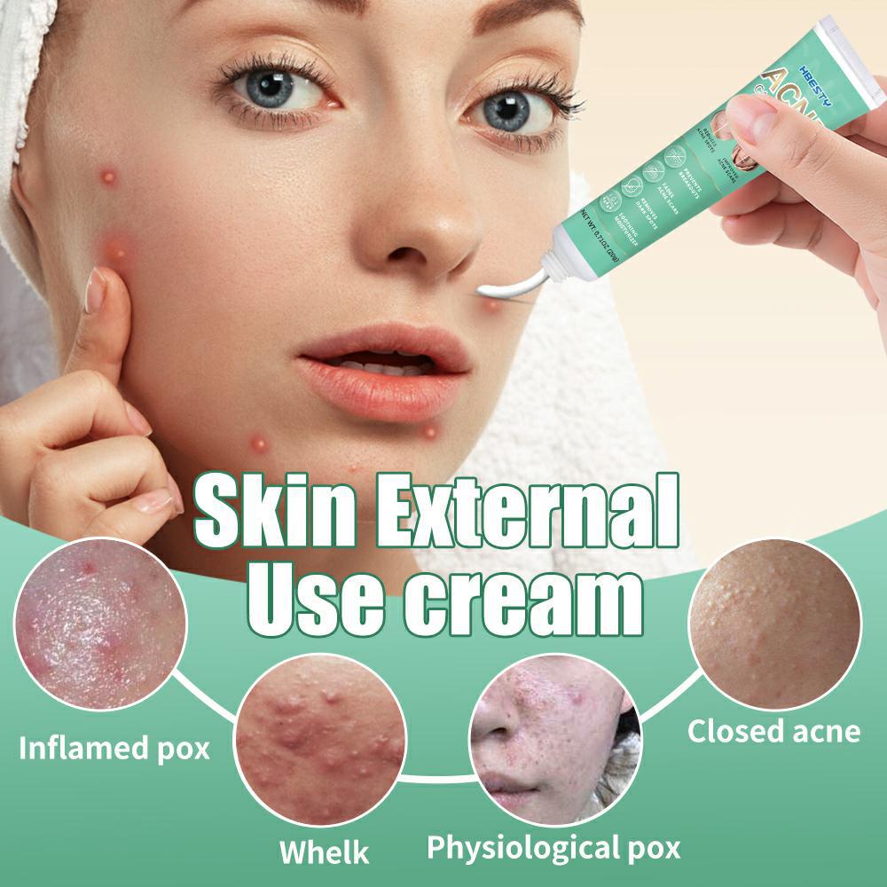Herbal Acne Treatment Cream