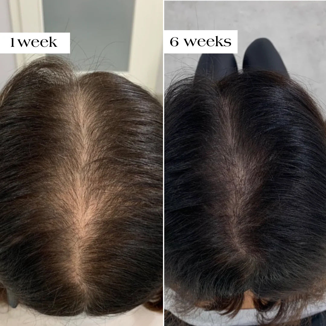 Hair Growth Microneedle Serum Essence